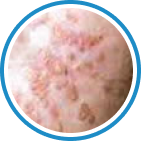 Verruca Plana — Düz Siğil kriyoterapi tedavisi