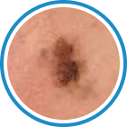 Güneş Lekesi (Lentigo) kriyoterapi tedavisi