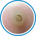 Plantar Siğil — Verruca Plantaris kriyoterapi tedavisi