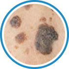 Seboreik Keratoz kriyoterapi tedavisi